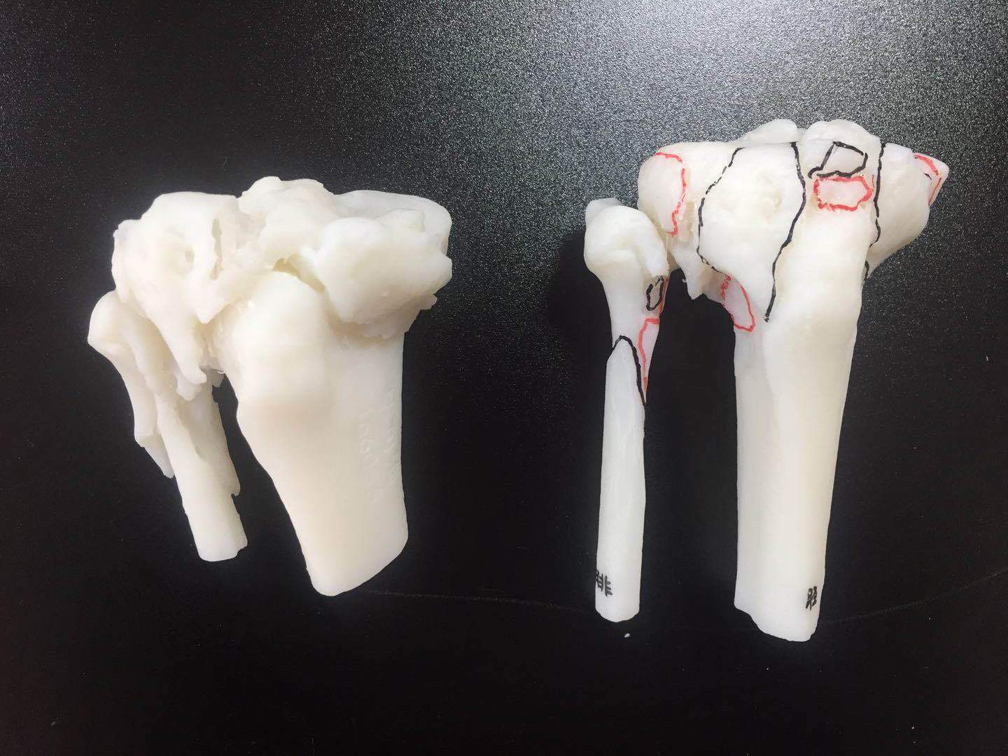 胫腓骨近端粉碎性骨折复位前 复位后模型 医学3d打印案例 医学3d打印应用 医学3d打印机 3d打印在医学上的应用 3d打印成功案例